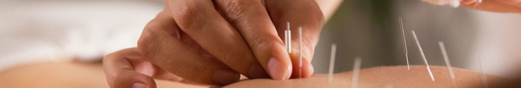 Acupuncture