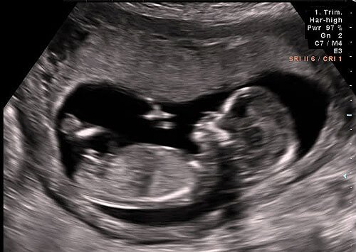 Ultra Sound Gender