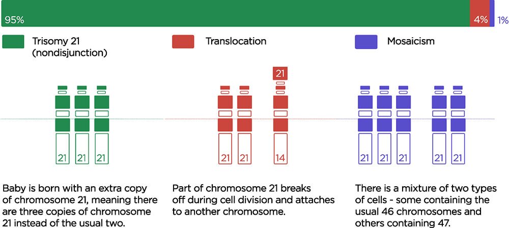 Down syndrome types